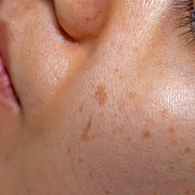 What To Know About Hyperpigmentation