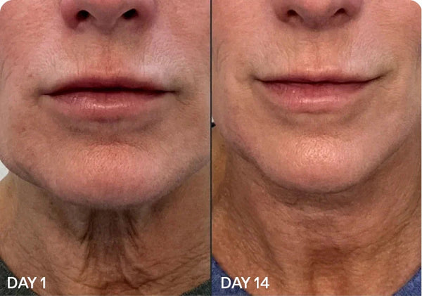 'Comparison of neck skin appearance before and after 14 days.'