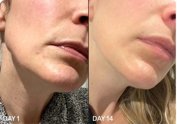 Side-by-side comparison of chin on Day 1 and Day 14 showing skin improvement.