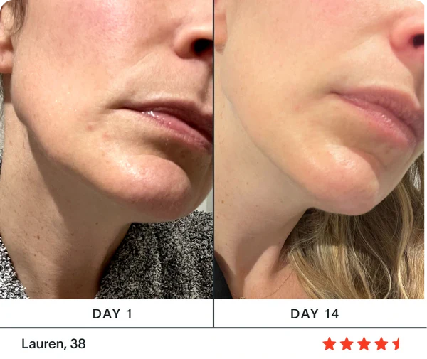 Before and after results, Lauren