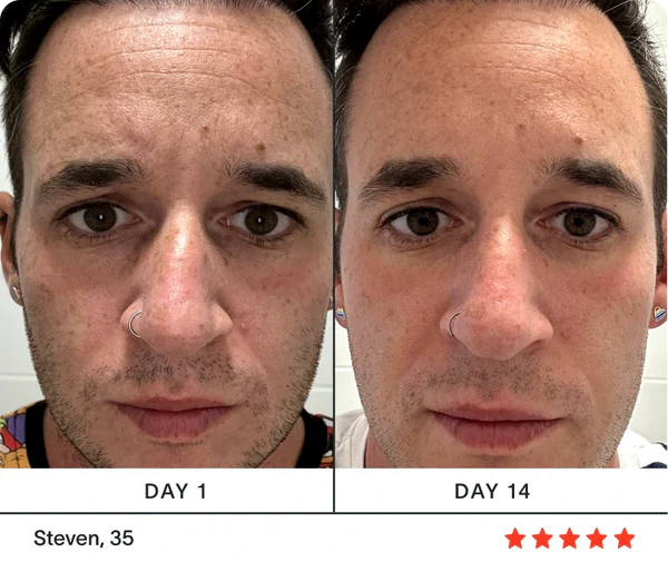 Before and after results, Steven 35