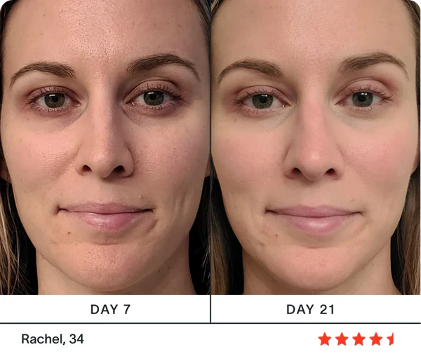 Before and after results, Rachel 34