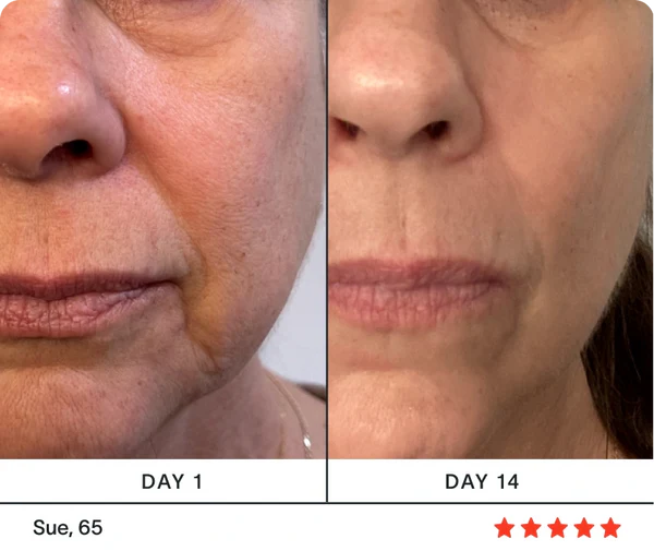 Before and after results, Sue