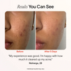 Before and after comparison of skin with acne, showing a positive response to treatment. before-after || Charcoal