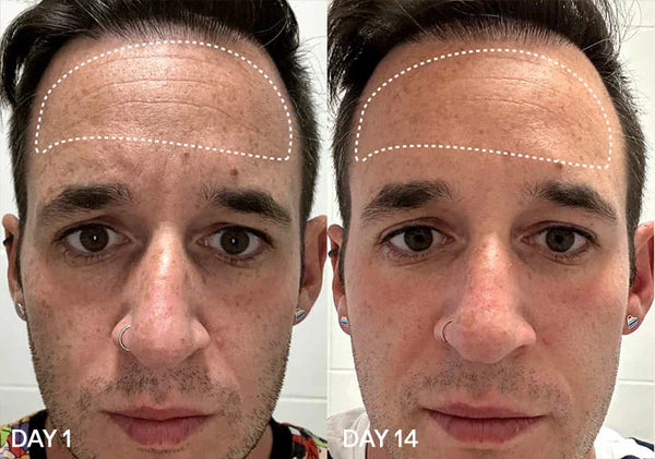 Before and after photos showing forehead improvement over 14 days.